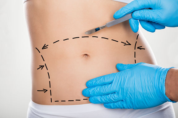 Abdominoplastik Herne